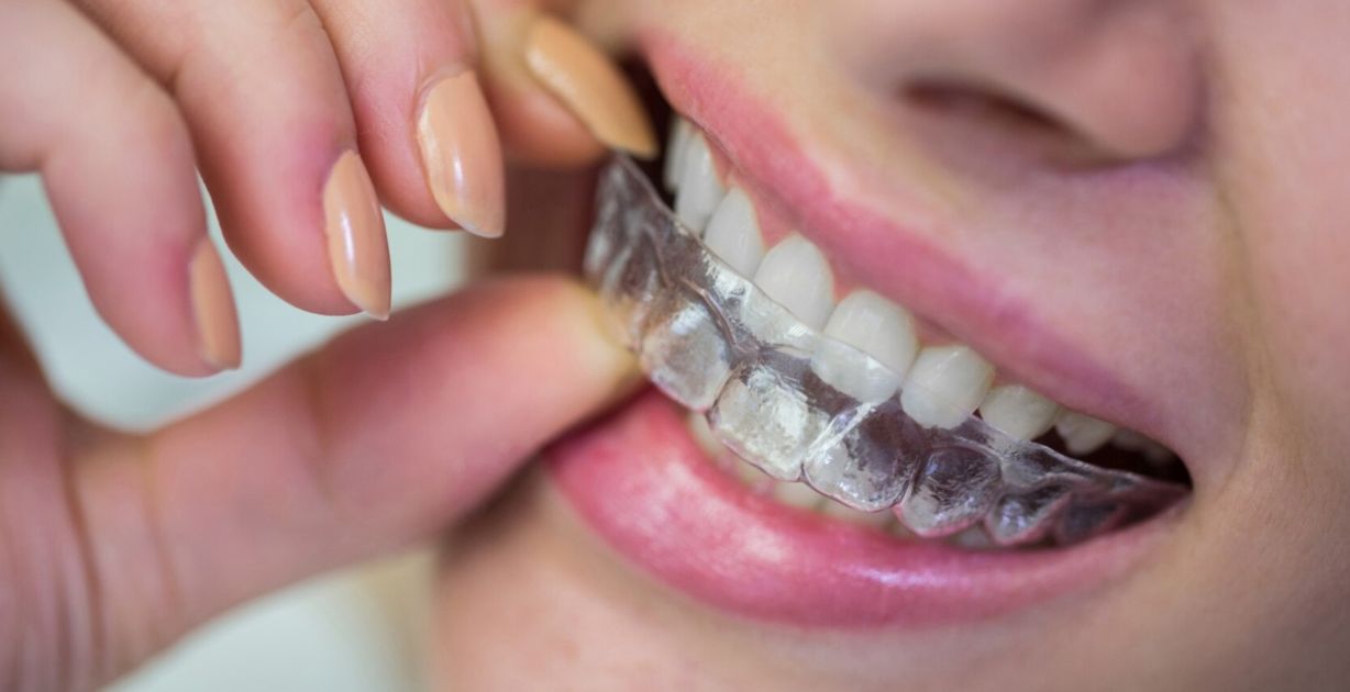 مثبت الاسنان بعد التقويم وأهم المعلومات عنه